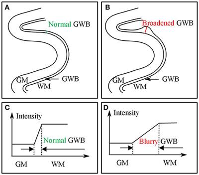 Local Directional Probability Optimization for Quantification of Blurred Gray/White Matter Junction in Magnetic Resonance Image